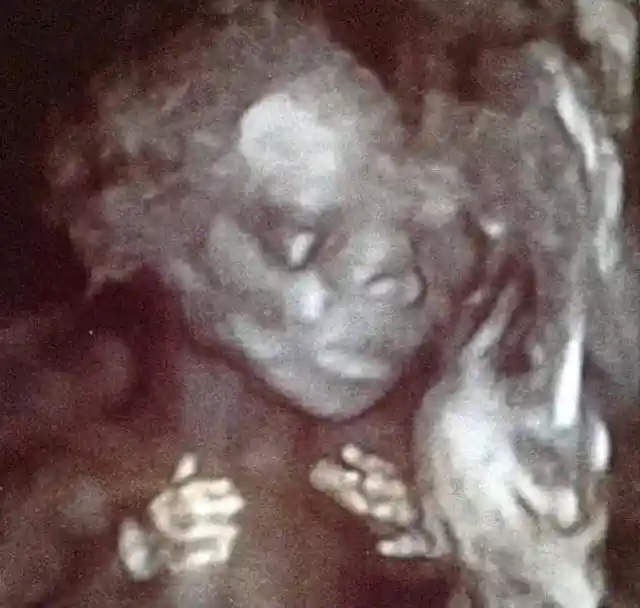 Woman&#8217;s Baby Bump Keeps Growing, Then Doctor Spots Something Unusual In Ultrasound