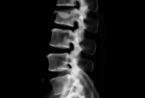 A Spinal Injury